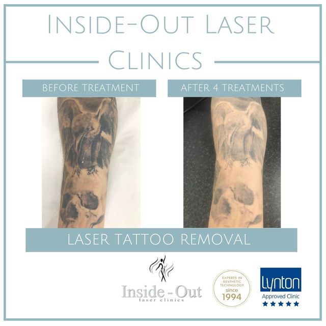 Inside Out Laser Clinic Leicestershire