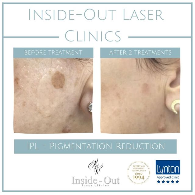 Inside Out Laser Clinic Leicestershire