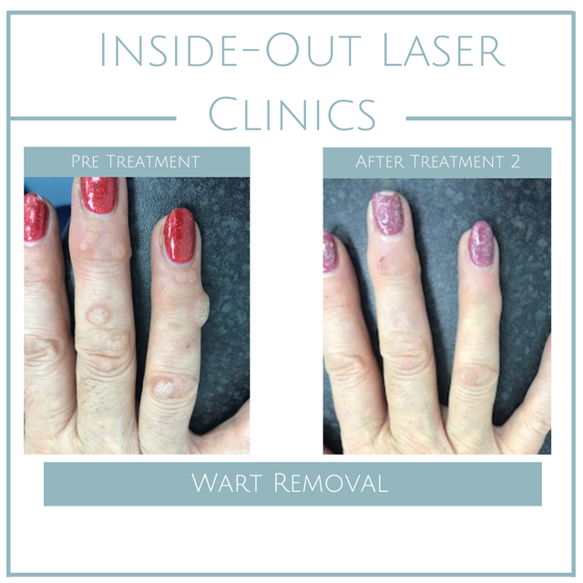 Inside Out Laser Clinic Leicestershire