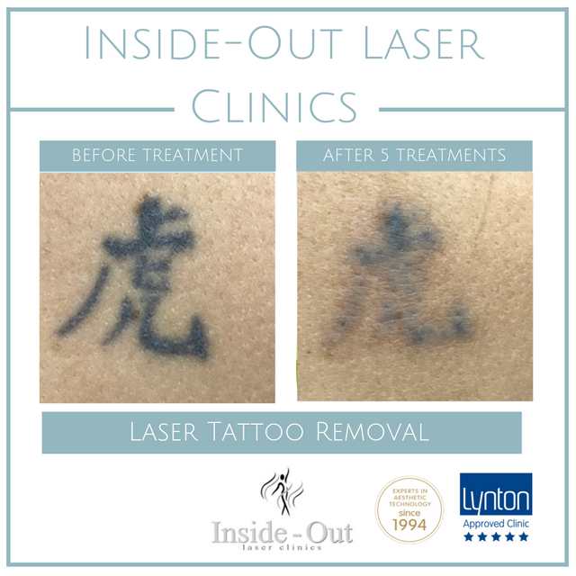 Inside Out Laser Clinic Leicestershire